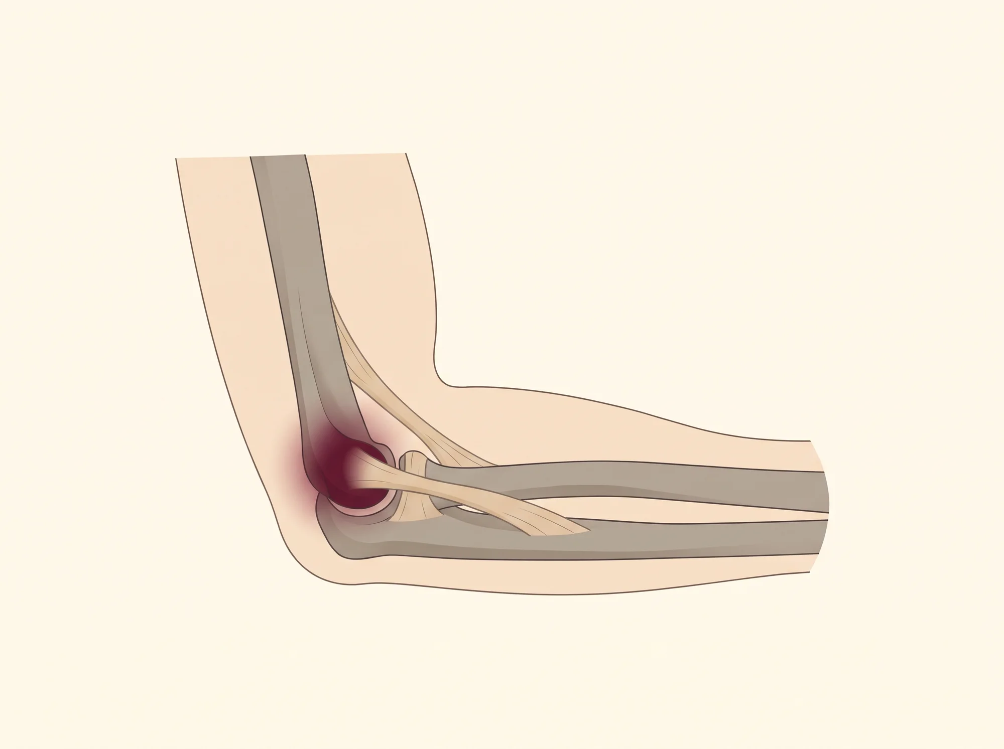 Illustrasjon av Lateral epikondylitt (tennisalbue)